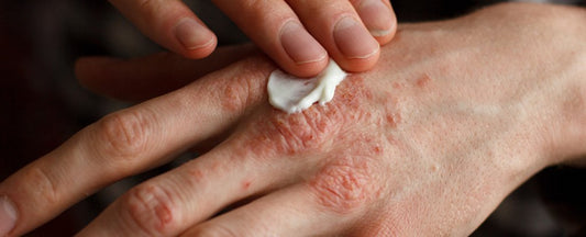 8 Reasons Why You Should Treat Your Eczema With The Right Cream: A blog about preventing eczema from occurring.